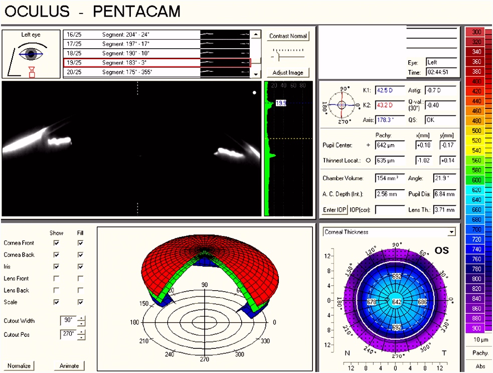 Descemet membrane endothelial keratoplasty DMEK for Fuchs